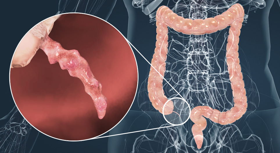 Appendicitis