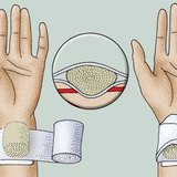 Aplicar uma ligadura de compressão