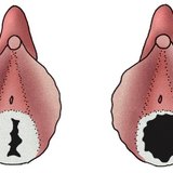 Hímen de mulher jovem (esquerda) e de mulher adulta com vida sexual ativa (direita)