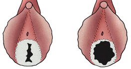 Hymen of young girl (left) and woman living active sexual life (right)