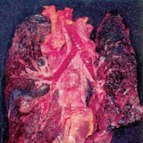 The lung of a smoker