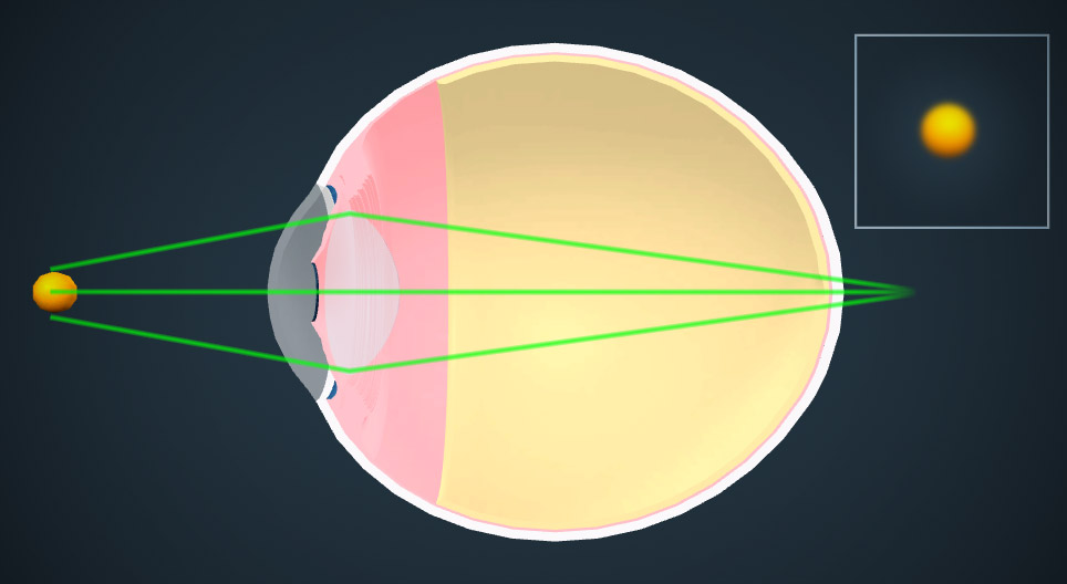 Correção da visão